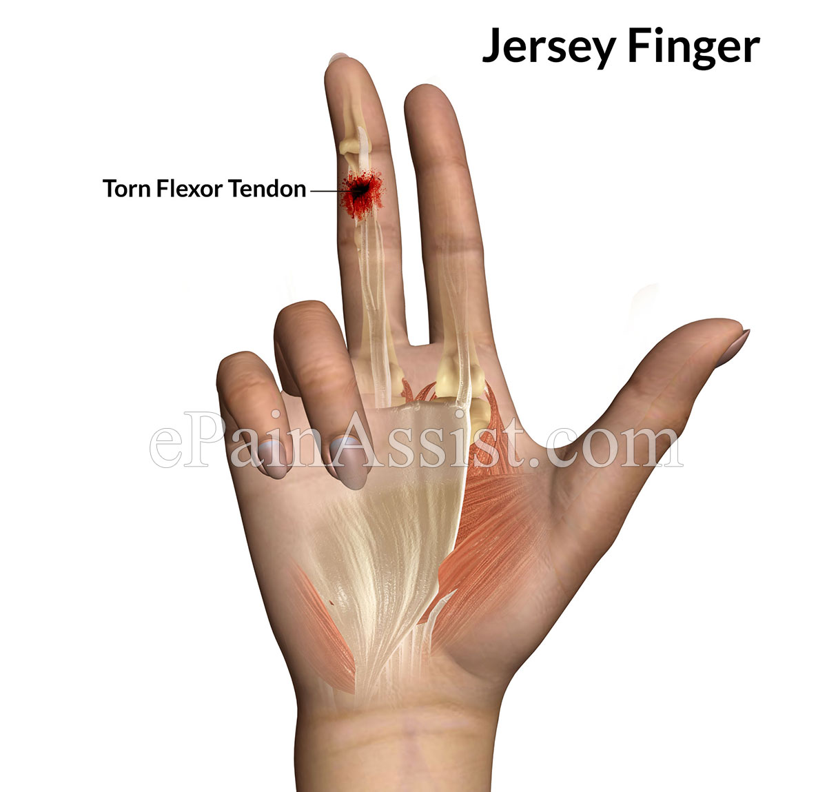 Jersey Finger or Football Finger Jersey Finger or Football Finger