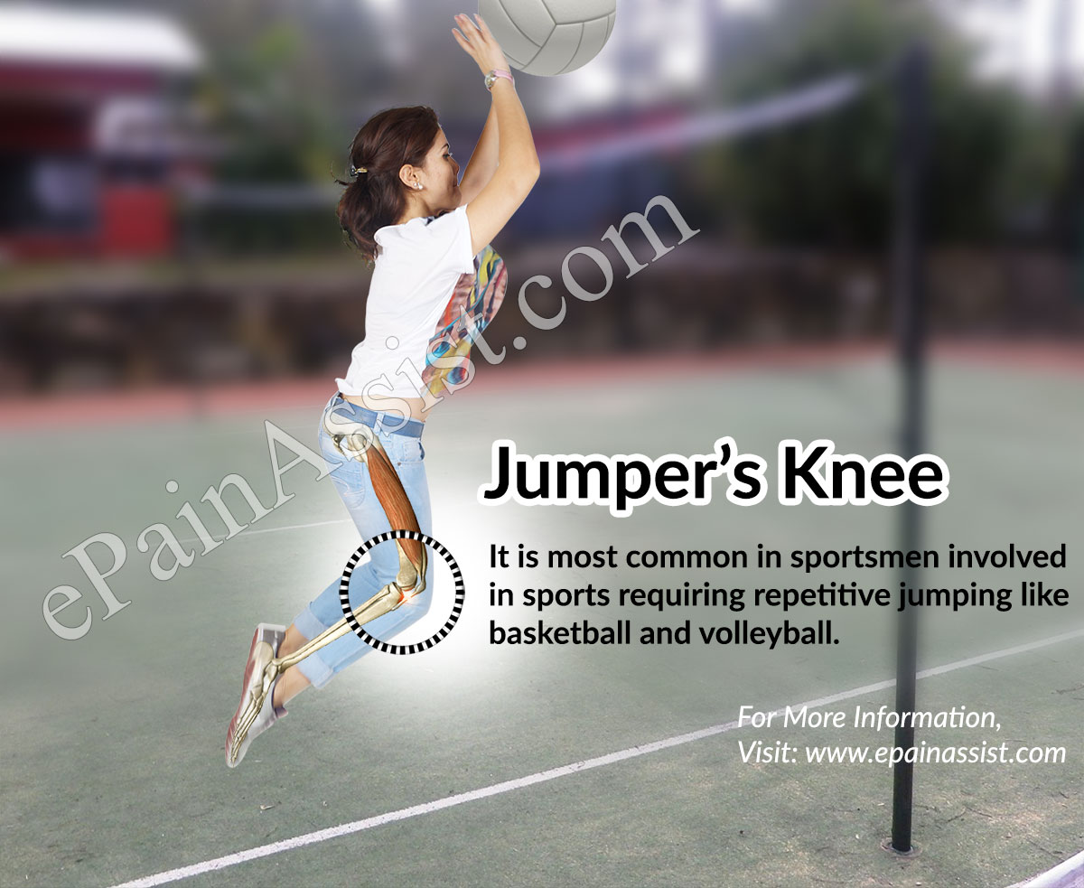 What is Patellar Tendonitis or Jumper's Knee? title=