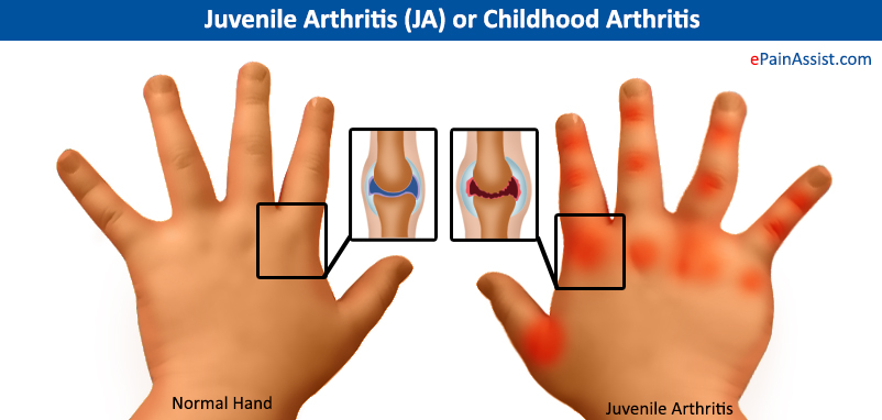 Juvenile Arthritis (JA) or Childhood Arthritis