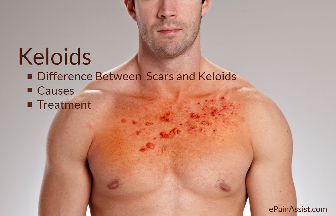 Keloids, Difference b/w Scars and Keloids, Causes, Treatment