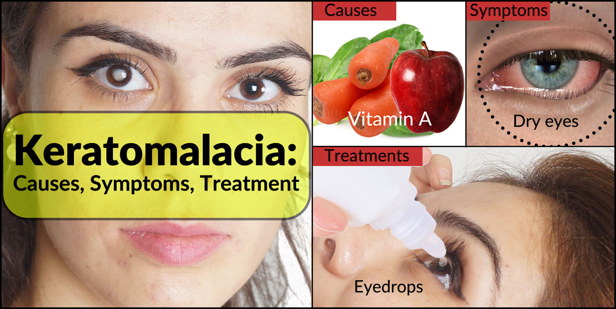 Keratomalacia Treatment Causes Symptoms