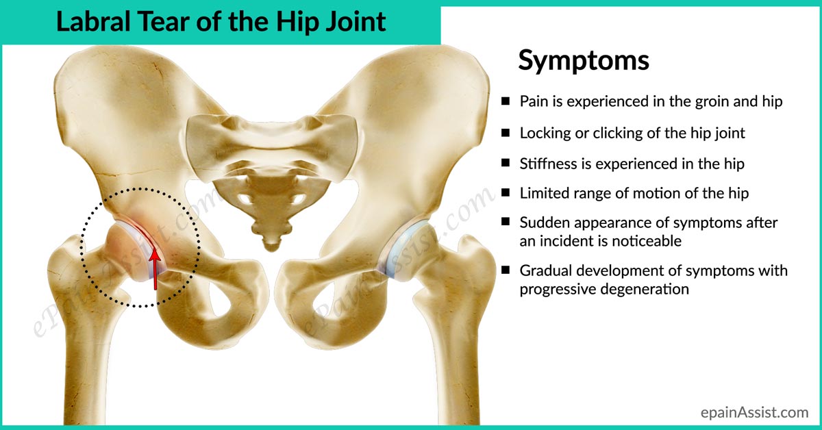 What is hip pain a symptom of?