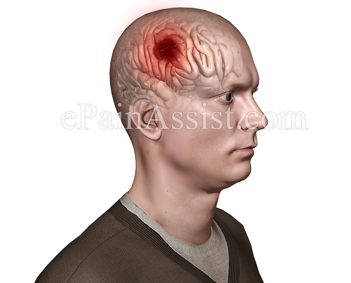 Brain Malignant Tumor. Brain Malignant Tumor.