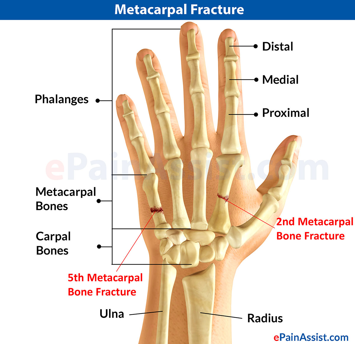 Metacarpal Fracture Metacarpal Fracture