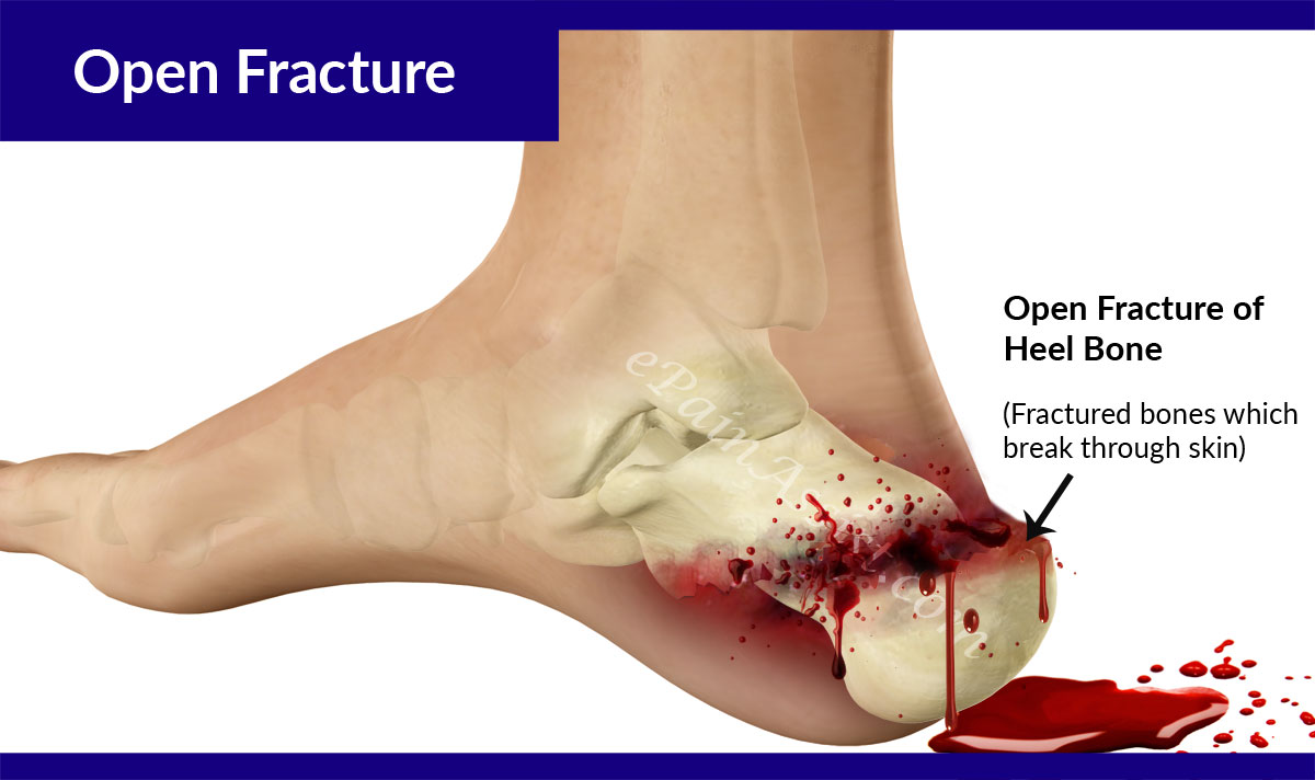 Calcaneus Fracture or Broken HeelTreatmentRecoverySymptomsTypesCauses