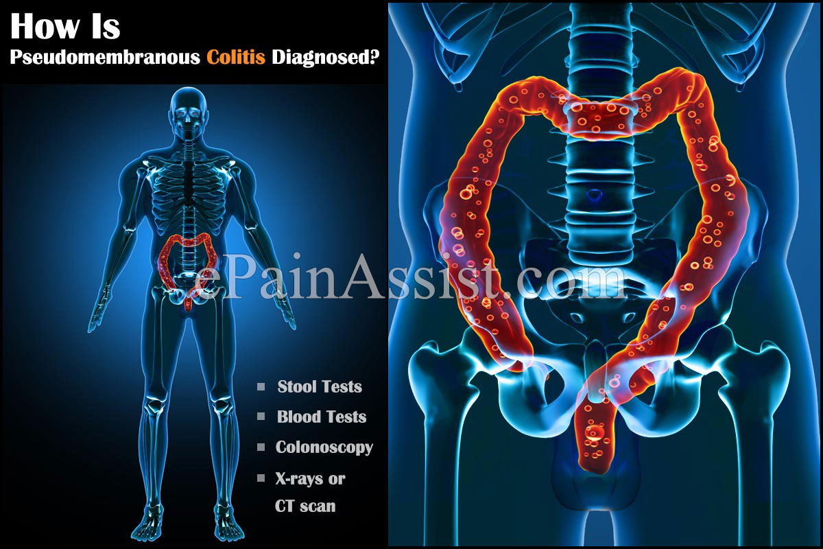 What Is Pseudomembranous Colitis? What Is Pseudomembranous Colitis?