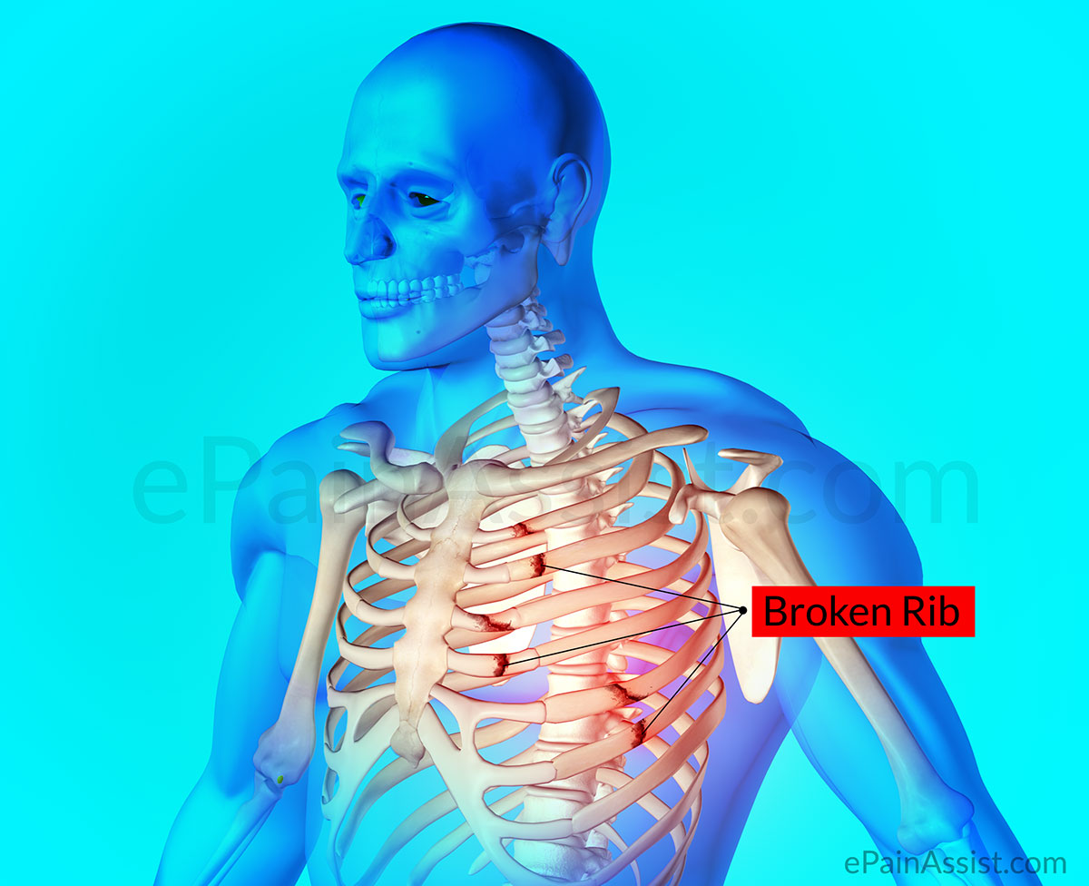 Rib Fracture or Broken Rib|Causes|Symptoms|Diagnosis|Treatment-Ice, NSAIDs