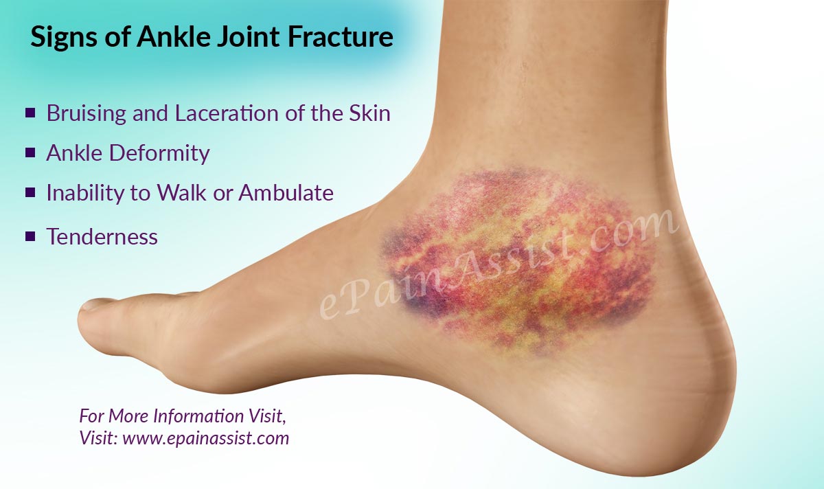 What are the Symptoms of Ankle Joint Fracture or Broken Ankle?