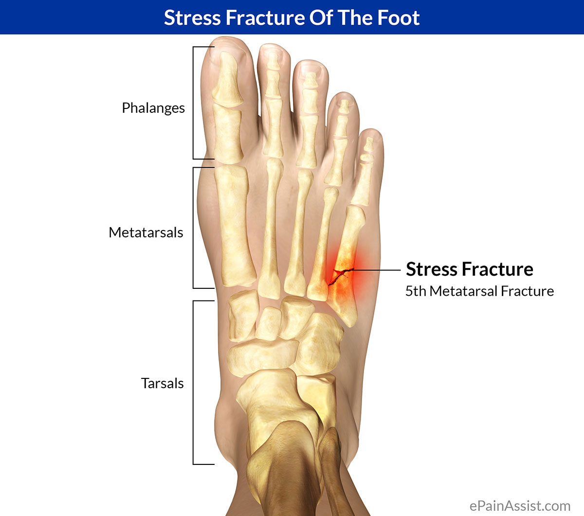 What are some reasons for stress fracture in the fifth metatarsal bone?