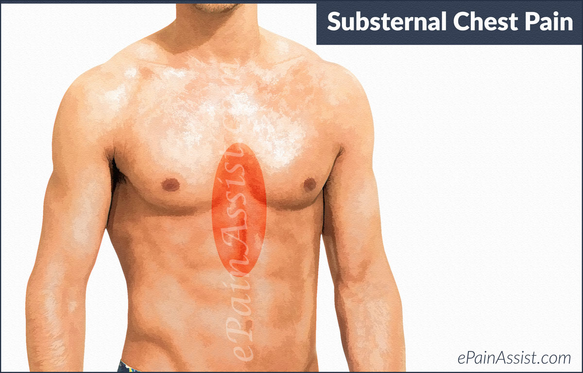 What Is Substernal Chest Pain?