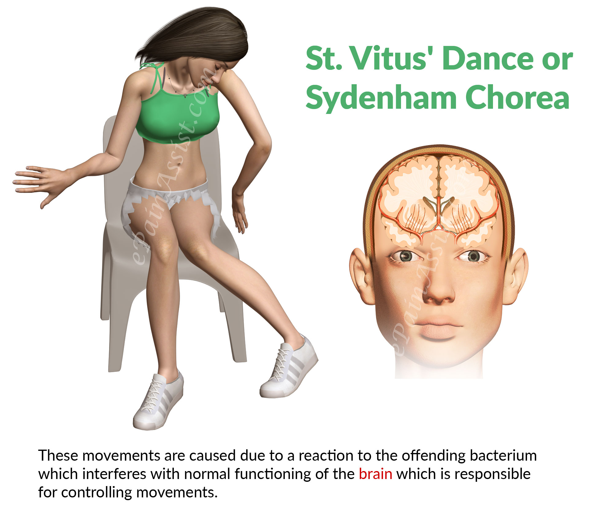 What is the medical term for the condition known as Saint Vitus' dance?