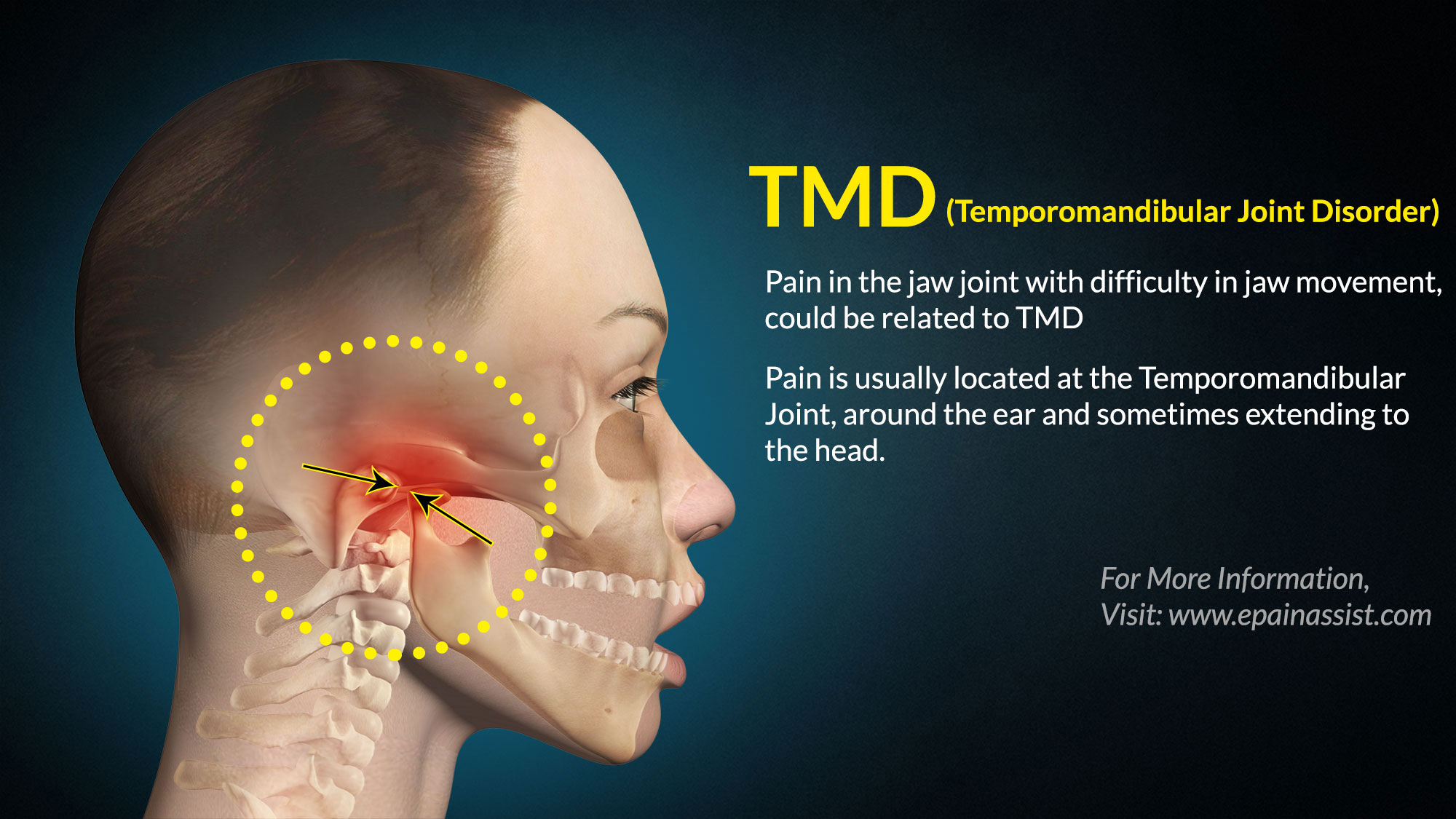 Tmj Chart