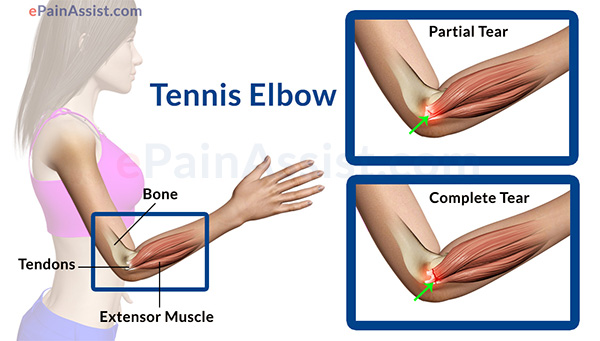 Tendon Injuries