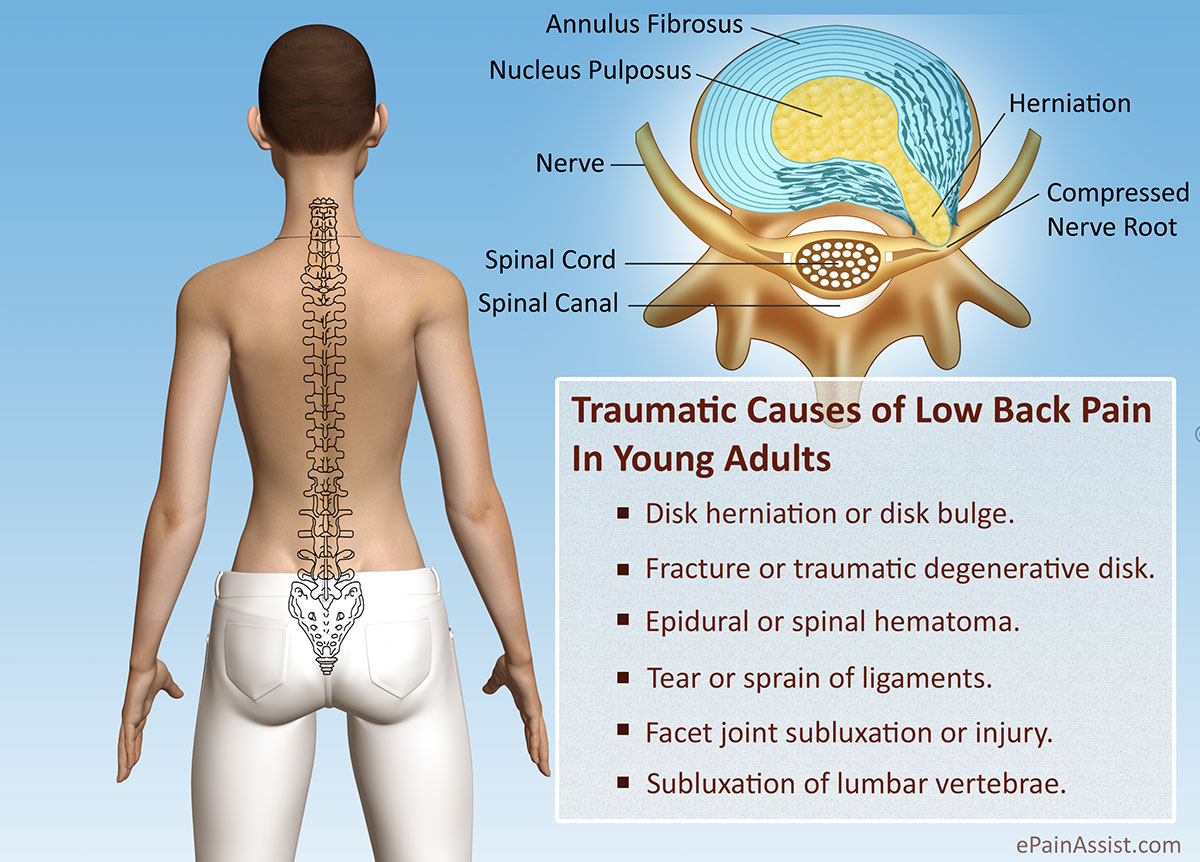 Traumatic Causes Of Low Back Pain Or Back Discomfort In Young Adults