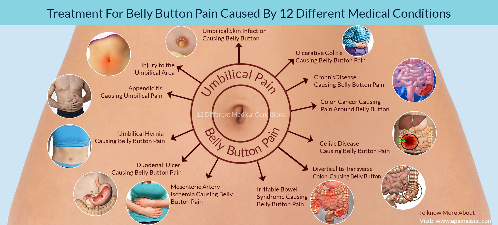 Treatment For Belly Button Pain Caused By 12 Different Medical Conditions