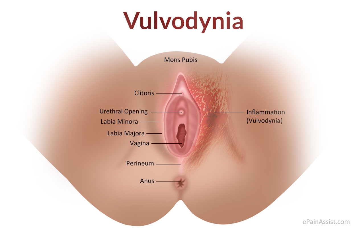 Vulvodynia Classification Types Etiology Risk Factors