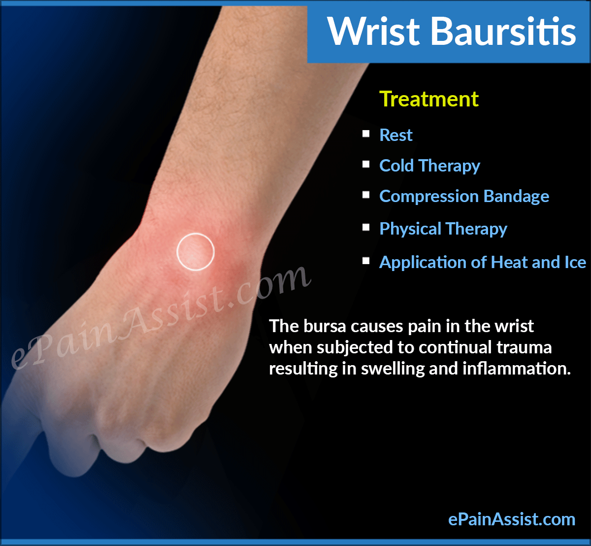 Wrist Bursitis
