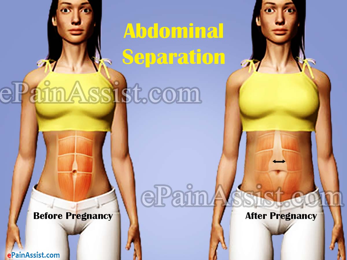 Abdominal Separation