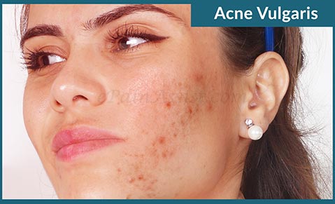 Acne or Acne Vulgaris Acne or Acne Vulgaris