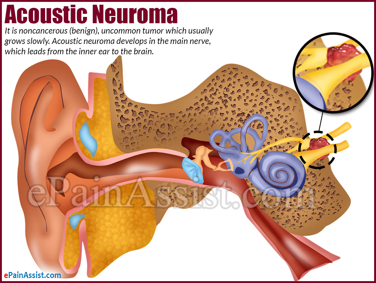 Acoustic Neuroma Acoustic Neuroma