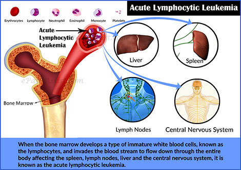 Acute Lymphocytic Leukemia Acute Lymphocytic Leukemia