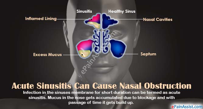 Acute Sinusitis Can Cause Nasal Obstruction Acute Sinusitis Can Cause Nasal Obstruction