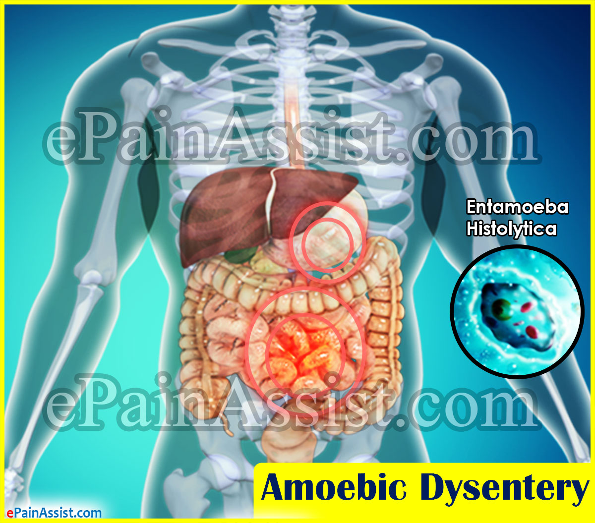 Amoebic Dysentery Amoebic Dysentery