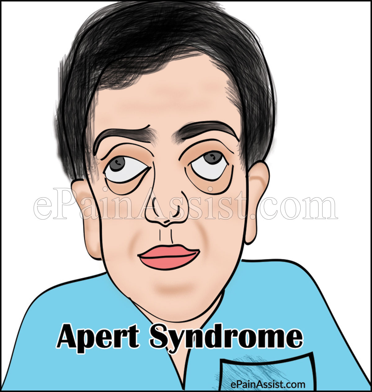 Apert Syndrome Apert Syndrome