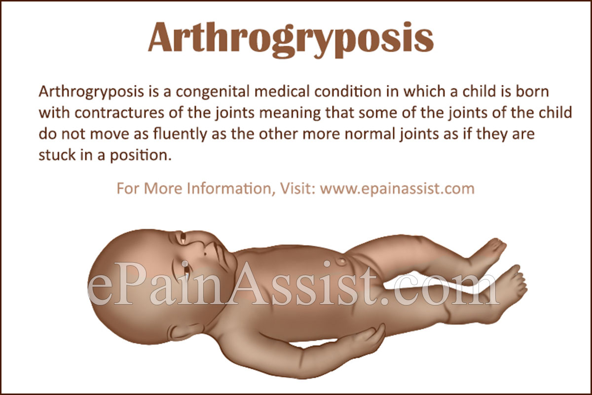 Arthrogryposis: Causes, Symptoms, Treatment