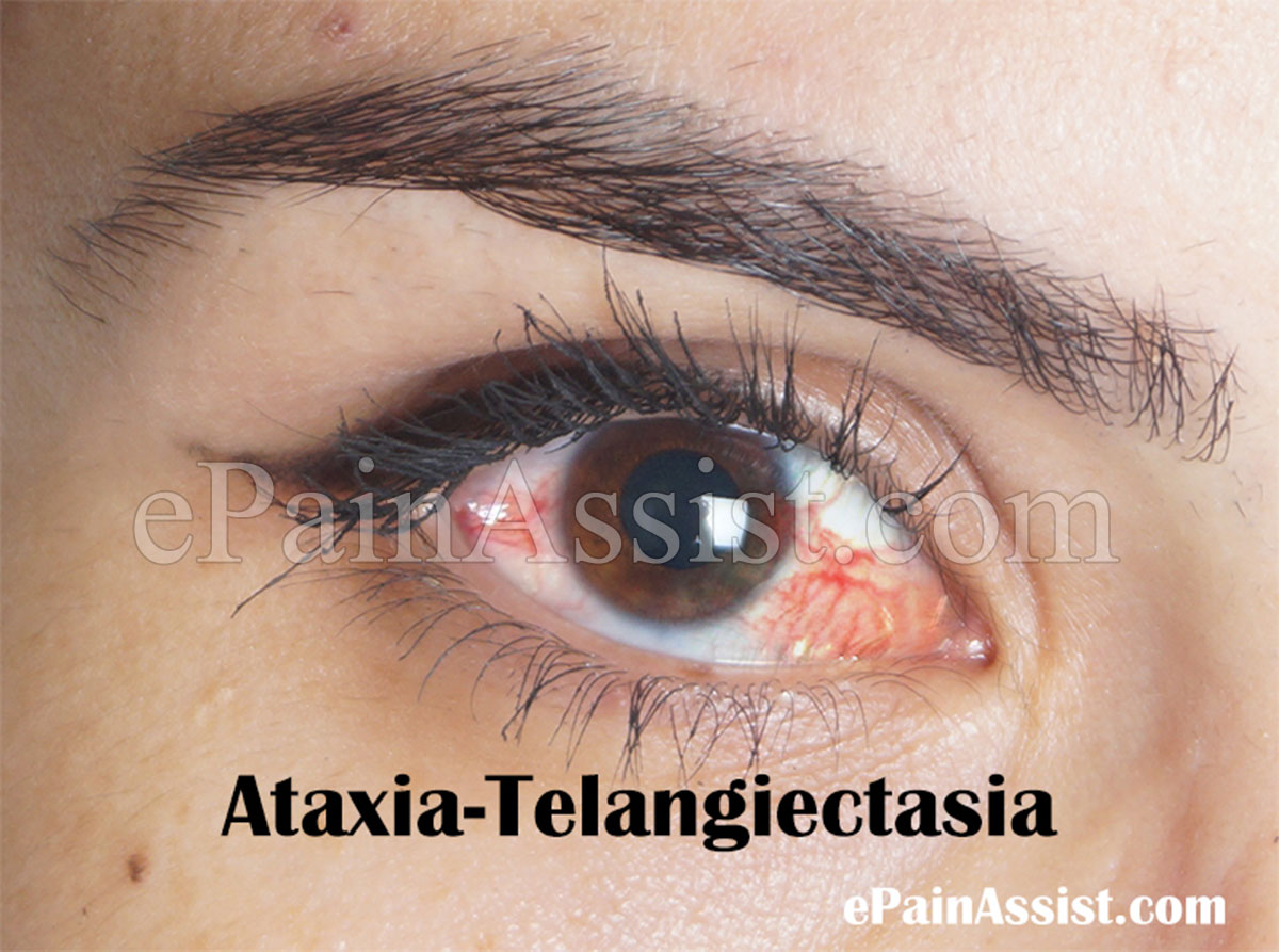 Ataxia Telangiectasia Or Louis Bar Syndrome Ataxia Telangiectasia Or Louis Bar Syndrome