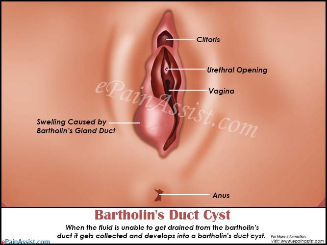 Bartholin's Duct Cyst