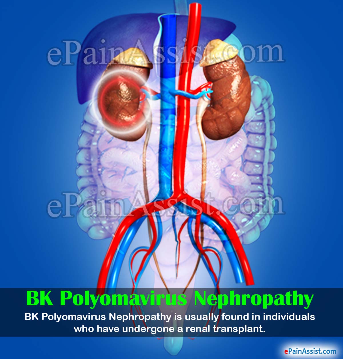 BK Polyomavirus Nephropathy BK Polyomavirus Nephropathy