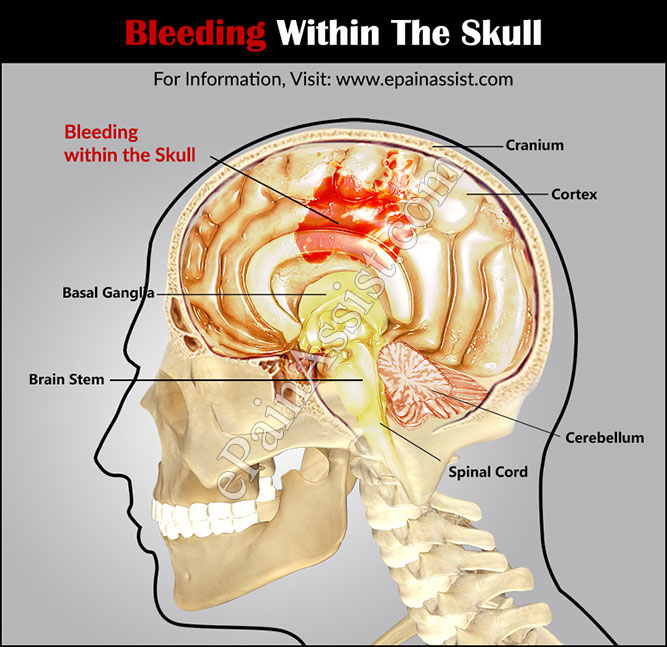 Bleeding Within the Skull