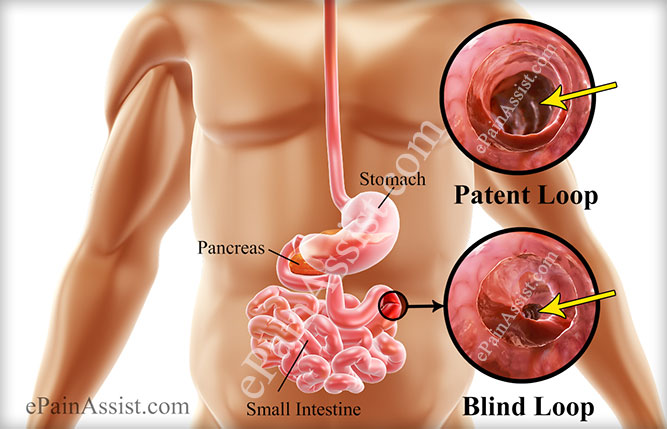 Blind Loop Syndrome or Stasis Syndrome