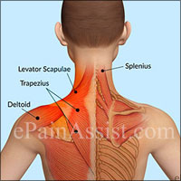 Upper Back and Neck Injuries|Whiplash|Kyphosis|Strain|Pulled Neck Muscles|