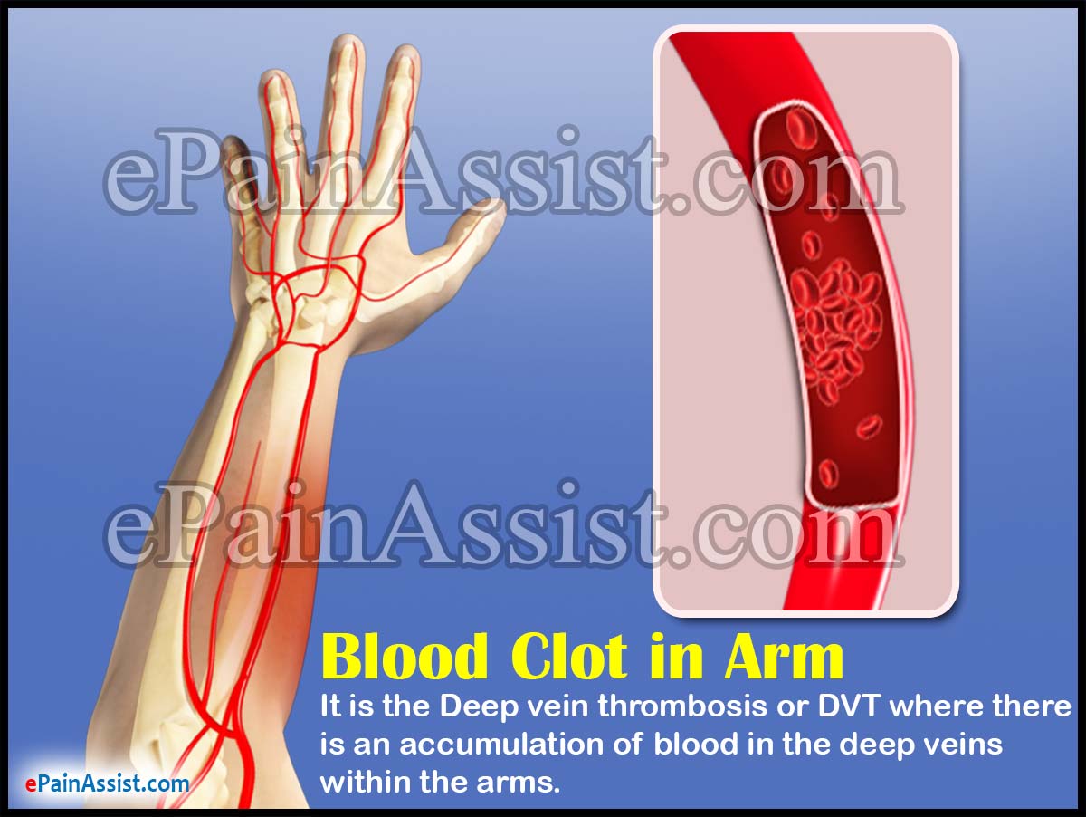 Blood Clot In Arm Symptoms Treatment Home Remedies Exercises Blood Clot In Arm Symptoms Treatment Home Remedies Exercises