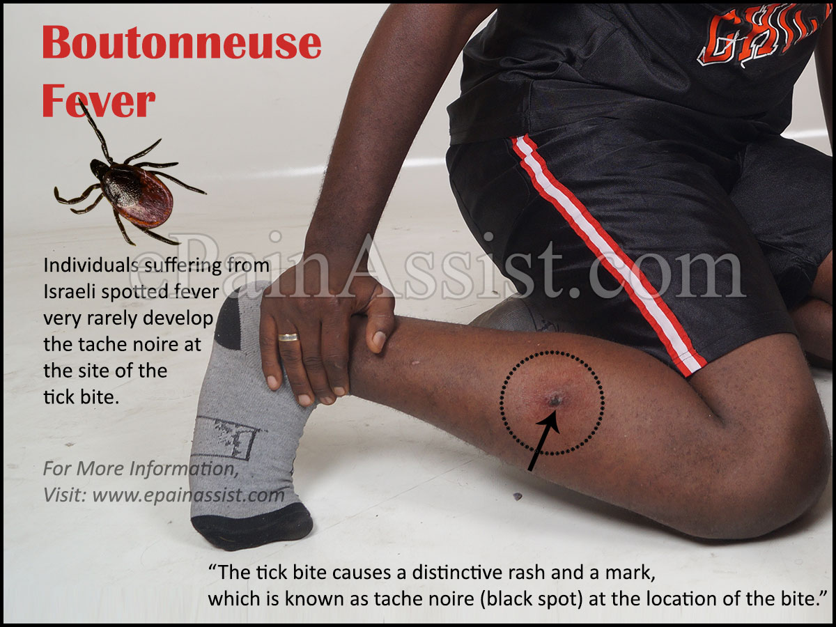 Mediterranean Spotted Fever or Boutonneuse Fever