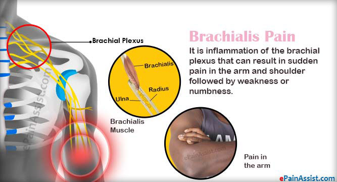 Brachialis Pain