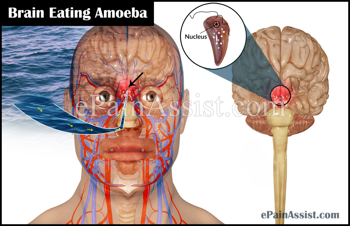 Brain Eating Amoeba or Naegleriasis Brain Eating Amoeba or Naegleriasis