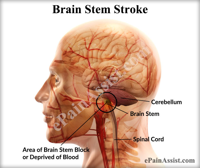 What is a Brain Stem Stroke?