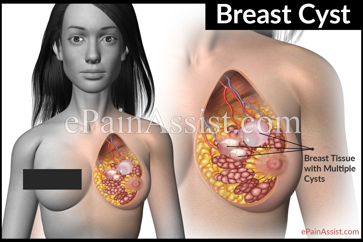 Breast Cyst - Causes, Symptoms, Treatment, Dos & Don’ts Breast Cyst - Causes, Symptoms, Treatment, Dos & Don’ts