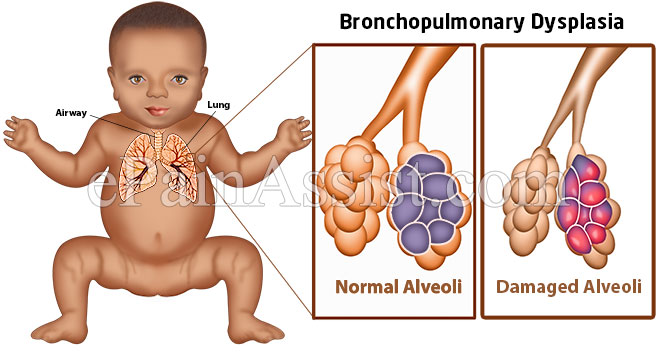 Bronchopulmonary Dysplasia (BPD) or Chronic Lung Disease of Infancy