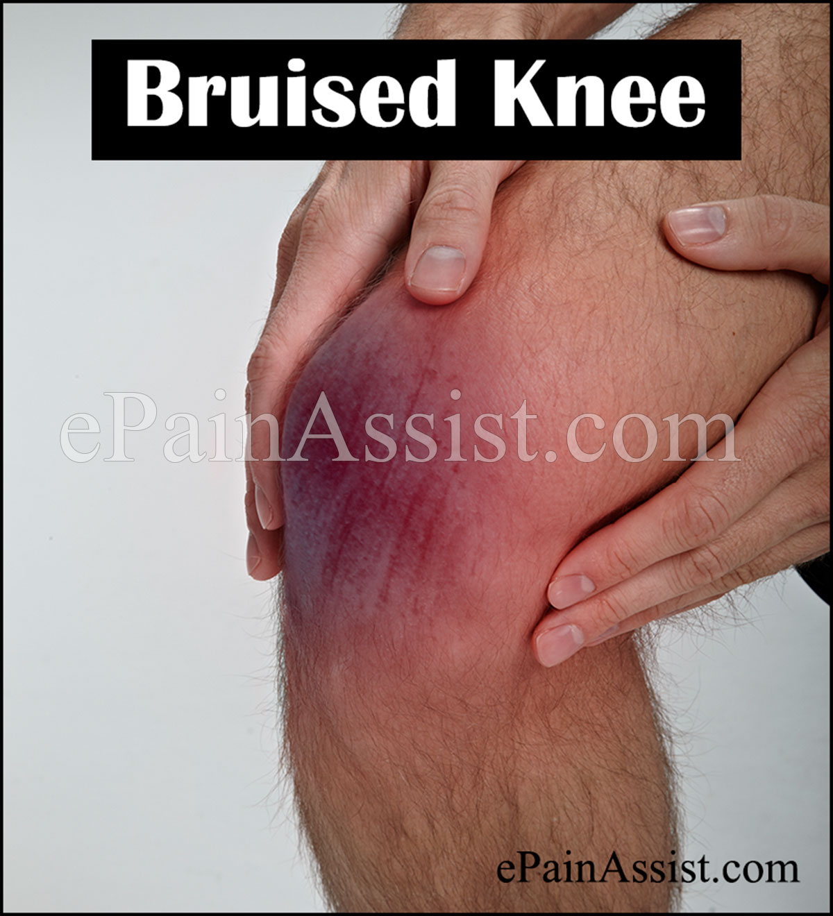 Knee Contusion (Bruised Knee) CausesSymptomsTreatment