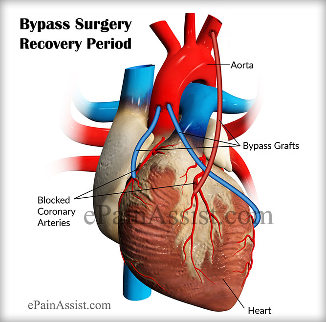 Bypass Surgery Recovery Period