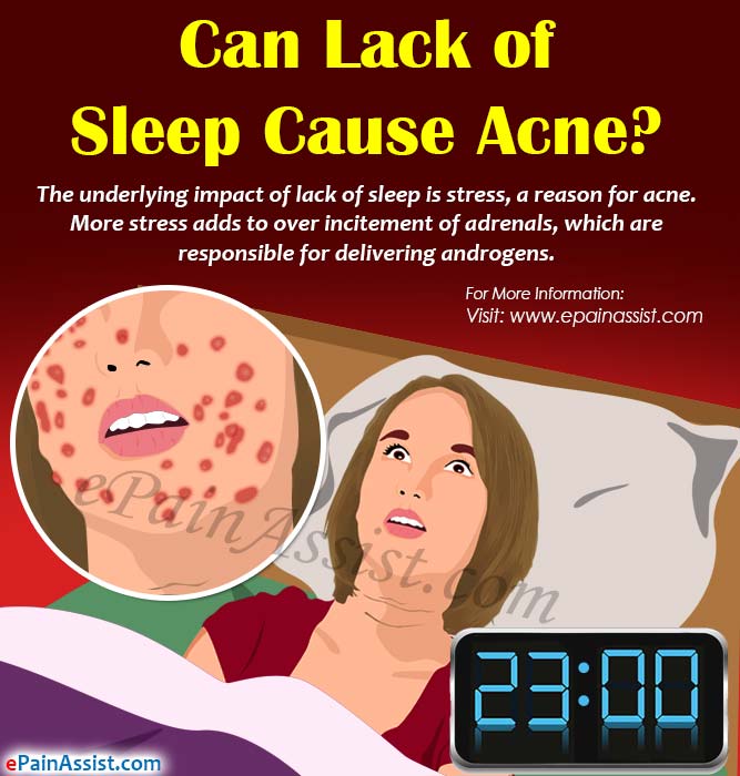 Can Lack of Sleep Cause Acne?