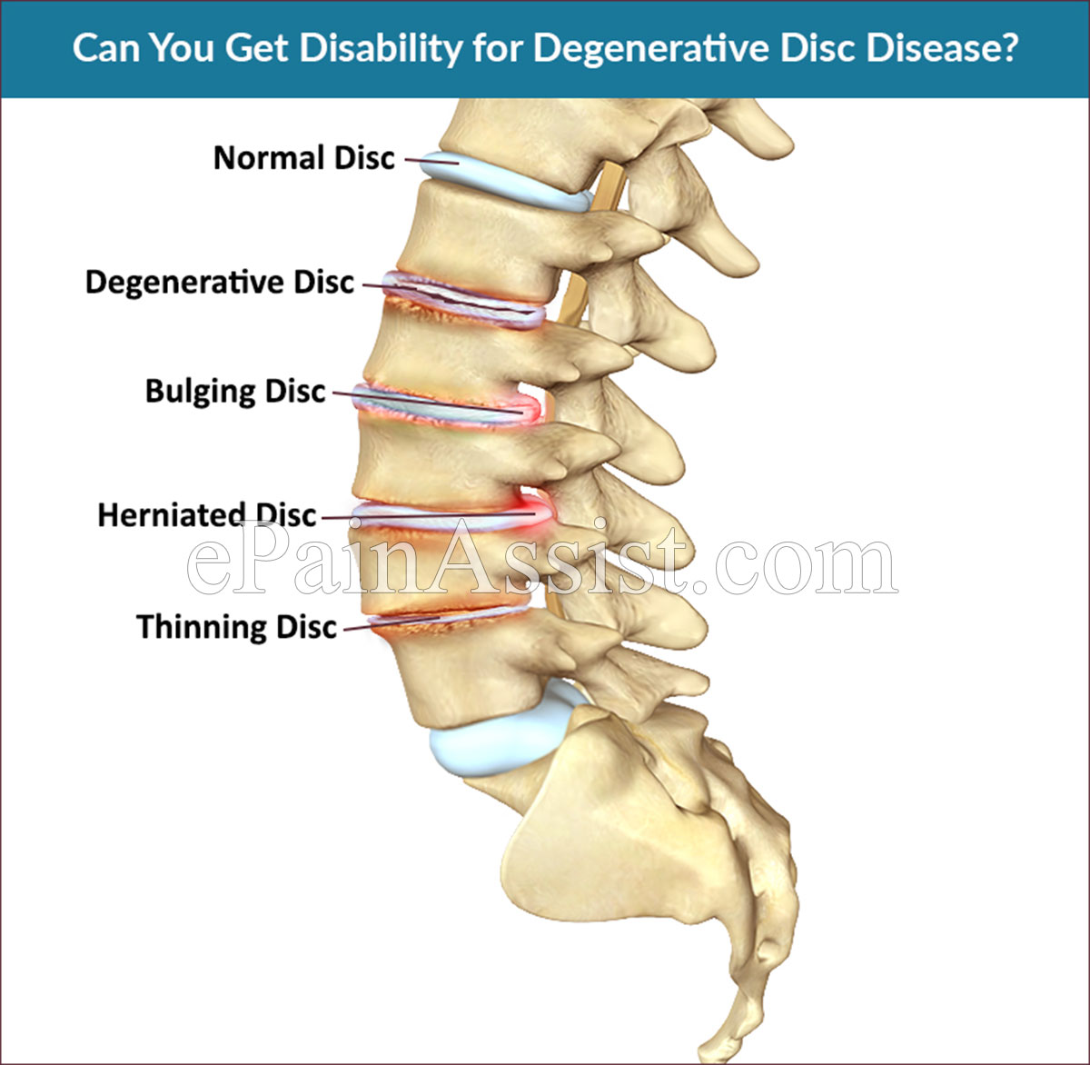 Disability Benefits For Degenerative Disc Disease Disability Benefits For Degenerative Disc Disease
