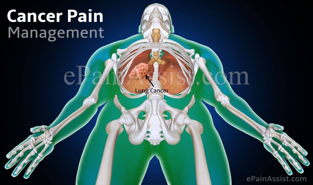 Cancer Pain Management Cancer Pain Management
