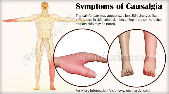 Symptoms of Causalgia