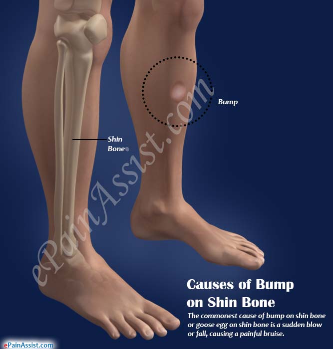 Causes of Bump on Shin Bone