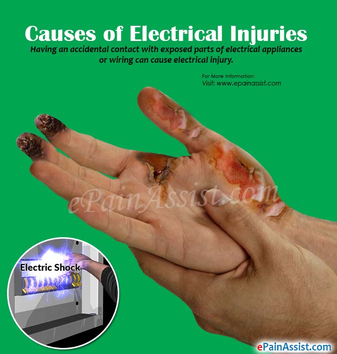 Causes of Electrical Injuries